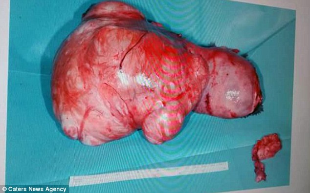 Gruas që dukej shtatzënë për tri vite i hoqen tumorin ne madhesi te shalqirit foto 3