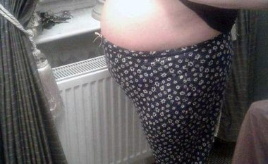 Gruas që dukej shtatzënë për tri vite, i hoqën tumorin në madhësi të shalqirit (Foto)