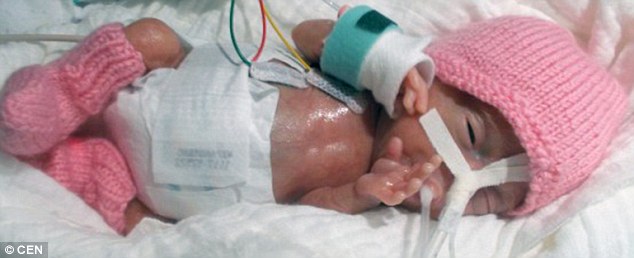 Mbijeton bebja e lindur me vetëm 230 gramë foto 2