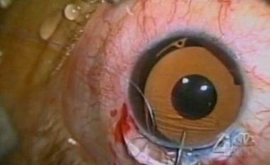 Ja si duket operacioni i ndryshimit të ngjyrës së syve (Video shqetësuese)