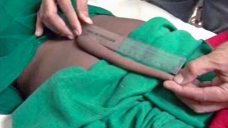 Njihuni me adoleshentin që pas ndërhyrjes kirurgjikale, hoqi bishtin 20 centimetra që e kishte në shpinë (Foto/Video, +16)