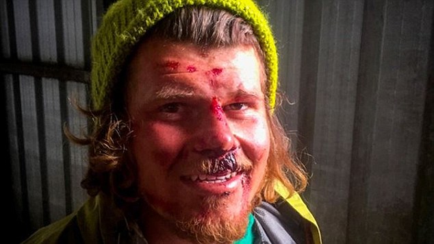 Alpinisti shfaqë fytyrën e lënduar pasi përjetoi ortekun foto 2