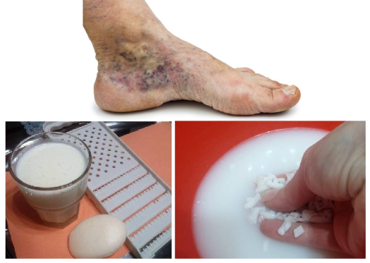 Magical-Recipe-for-Varicose-Veins-and-Thrombosis-with-Only-Two-Simple-Ingredients