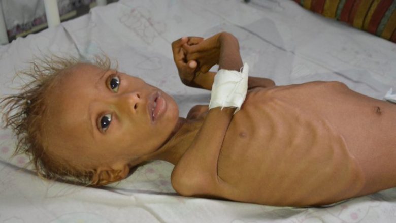 Pasojat e luftës në Jemen: Shërimi i fëmijës që zija e bukës e bëri asht e lëkurë (Foto)