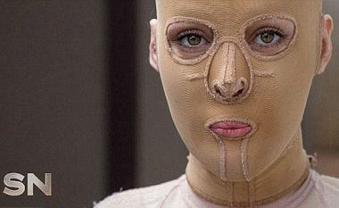 E djegur në 65 për qind të trupit të saj, vajza vendos të fotografohet pa maskë (Foto, +18)