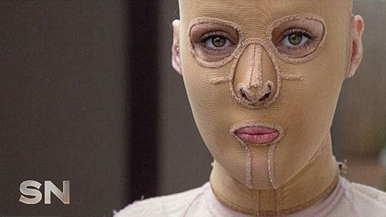 E djegur në 65 për qind të trupit të saj, vajza vendos të fotografohet pa maskë (Foto, +18)