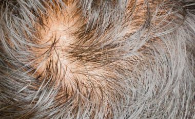 Lajm i mirë për tullacët: Shkencëtarët e kanë zbuluar kurën për rënien e flokëve