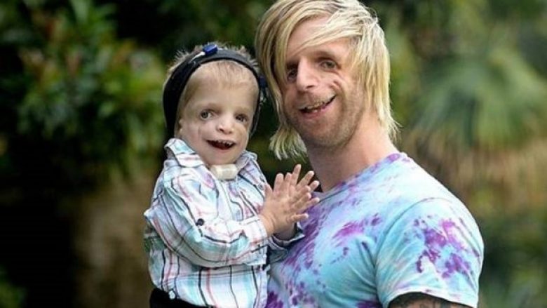 Udhëton nga Londra në Australi, që të fotografohet me djaloshin që vuan nga e njëjta sëmundje (Foto)