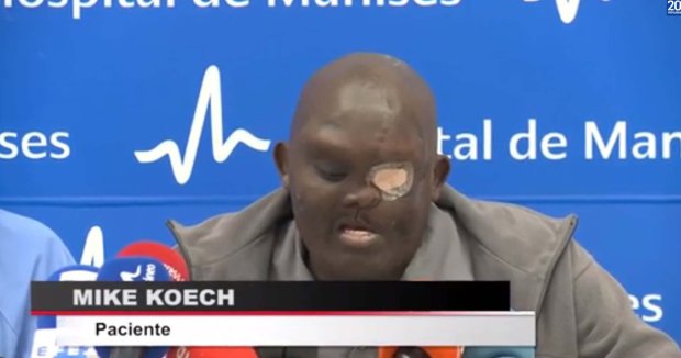 Pic shows: Mike Koech speaking at the conference (after surgery); A man with an astonishing facial tumour almost the size of his head is recovering after a series of operations to remove it. The giant tumour was so large it had blinded Kenyan-born Mike Koech in one eye and threatened to kill him as it continued to grow. Spanish surgeon Pedro Cavadas, 51, has told how if it had not been operated on it would have continued to grow and Koech would have "died miserably." The tumour began as a small growth which continued to grow until it had consumed one side of 35-year-old Koech's face. It became so large that his nose and mouth were pushed to one side and he lost his left eye. Surgeons in Kenya and India had abandoned attempts to operate, intimated by the sheer size of the growth. Cavadas explained: "The size of the tumour scared doctors in India, and in that country there are good hospitals." He added: "He was at the limit of being operated, but the alternative for Mike was to die miserably and any option was better than that." Cavadas - who heard about the case through the Red Cross - flew Koech to his clinic in Manises hospital, Valencia, through his charitable medical foundation. Now - after a series of four operations in 2011, 2013 and 2015 and October this year- Keoch is almost unrecognisable. Cavadas' team had to remove what remained of his left eye and part of his jaw, which is where the tumour had been regenerating itself. Now Koech - who lost both his legs in a childhood accident - is set to return to Kenya on Sunday (4th December) to return to his job as a motorbike taxi driver. Cavadas said: "We could never remove his right eye because he would not be able to take care of his family. "In addition, he is my friend and I made a pact with him, if we were not able to control the tumour, I would take care of his family." The pair became so close that Koech's newborn daughter was named Carmen, after the surgeon's late mother. Cavadas said: "During the process of recovery, Mike had a new daughter and he said that was thanks to me and he asked me to give her a name. "At that time my mother had just died and I gave her her name, Carmen, who would have cried a lot about his story. We have a half-daughter."