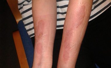 Çmenduria e radhës në internet: Sfida mazohiste që shkakton plagë në lëkurë (Foto, +16)