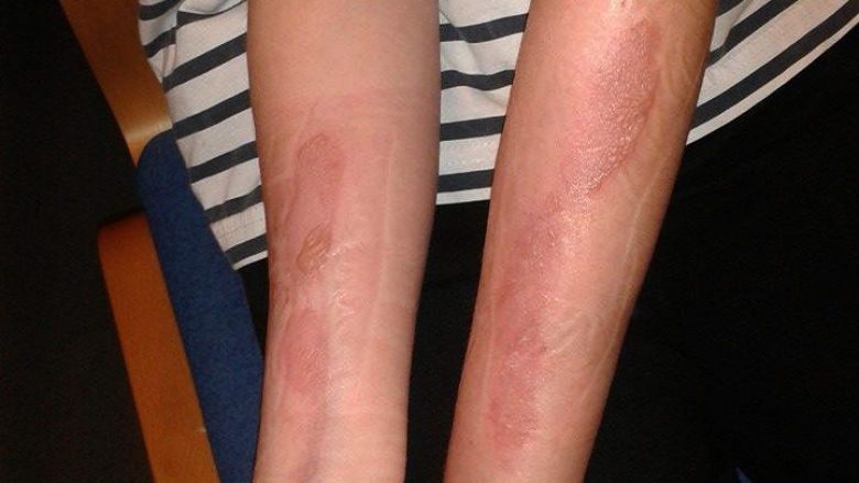 Çmenduria e radhës në internet: Sfida mazohiste që shkakton plagë në lëkurë (Foto, +16)