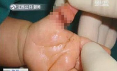 Fija e flokut të nënës i mbështjellët bebes për gishti, mjekët ia shpëtojnë nga amputimi (Foto)