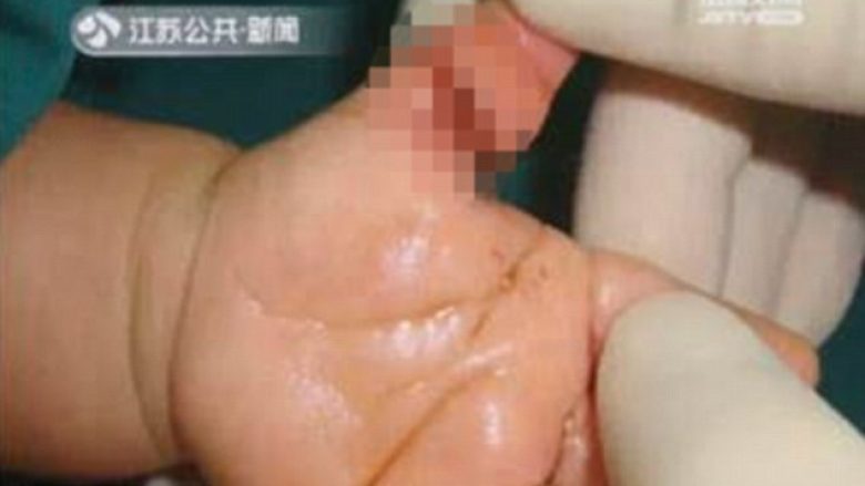 Fija e flokut të nënës i mbështjellët bebes për gishti, mjekët ia shpëtojnë nga amputimi (Foto)