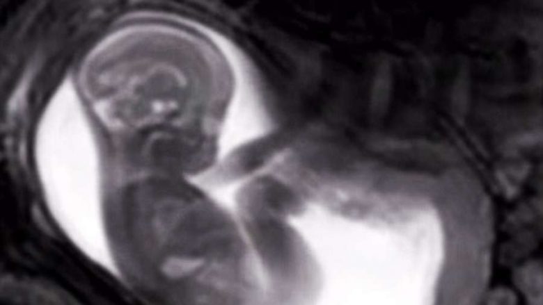 Sukses i pabesueshëm në mjekësi: Është bërë fotografimi më i hollësishëm i fetusit deri tani (Video)