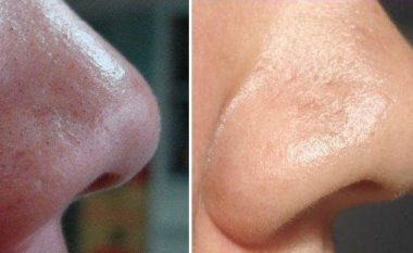 Metodë natyrale me vezë për heqjen e pikave të zeza në hundë