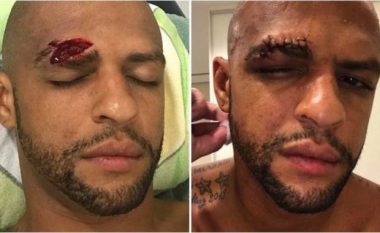 Felipe Melo nuk ndryshon, 13 qepje në fytyrë dhe vazhdoi lojën me fashë në kokë (Foto/ Video)