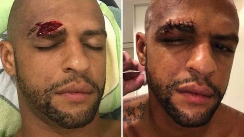 Felipe Melo nuk ndryshon, 13 qepje në fytyrë dhe vazhdoi lojën me fashë në kokë (Foto/ Video)