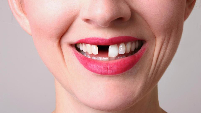 Numri i dhëmbëve që i keni nxjerrë do t’jua zbulojë sa gjatë do të jetoni