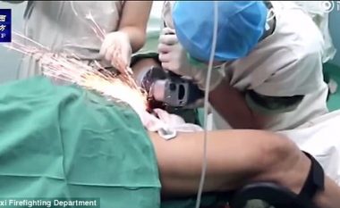 Plaku vendosi një “unazë” në penis, mjekët përdorën “brusalicën” për t’ia larguar! (Video)
