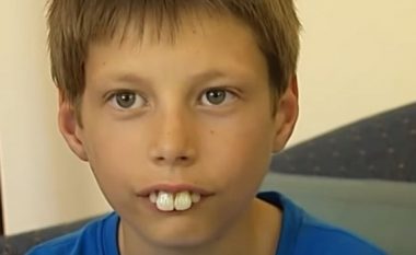 Bashkëmoshatarët e tallnin për shkak të dhëmbëve duke e quajtur “djaloshi lepur”, pas ndërhyrjes kirurgjike gjërat ndryshuan plotësisht (Foto/Video)