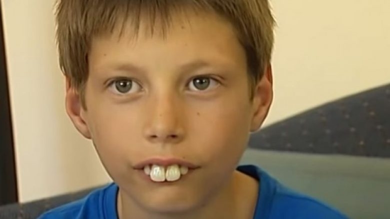 Bashkëmoshatarët e tallnin për shkak të dhëmbëve duke e quajtur “djaloshi lepur”, pas ndërhyrjes kirurgjike gjërat ndryshuan plotësisht (Foto/Video)