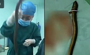 Mjekët i nxjerrin nga anusi ngjalën gati gjysma metri të gjatë – arsyeja pse e kishte futur brenda është bizare (Video)