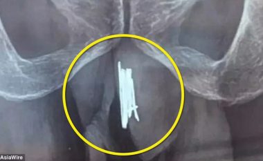 Mjekët ia nxjerrin 15 gjilpërat në penis, të cilat ia kishte ngulur vetes për një arsye bizare (Foto)