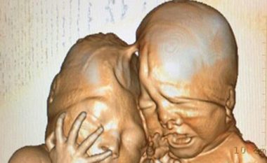 Ndahen binjaket që lindën të ngjitura (Foto)