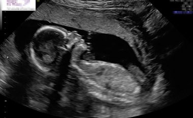 Pamje e pazakontë në pajisjen e ultrazërit: Fëmija i palindur, “përshëndet” me dorë (Foto)