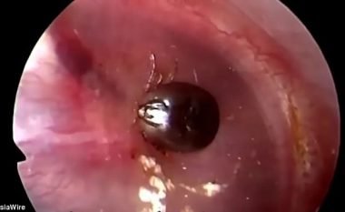 Mjekët ia nxorën me vështirësi insektin nga veshi (Video, +16)