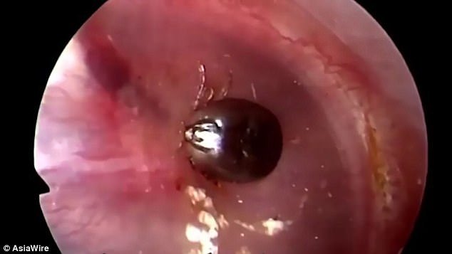 Mjekët ia nxorën me vështirësi insektin nga veshi (Video, +16)