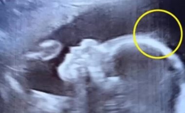 Shtatzëna ka shkuar për kontroll te mjeku: Nuk u ka besuar syve të vet çfarë ka parë në ultrazë! (Video)