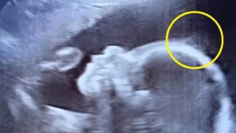 Shtatzëna ka shkuar për kontroll te mjeku: Nuk u ka besuar syve të vet çfarë ka parë në ultrazë! (Video)