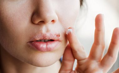 Keni herpes në buzë: Çfarë po ndodh në organizmin tuaj?