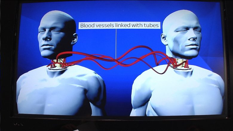Transplantimi i parë i kokës, do të kryhet te një pacient kinez (Foto/Video)