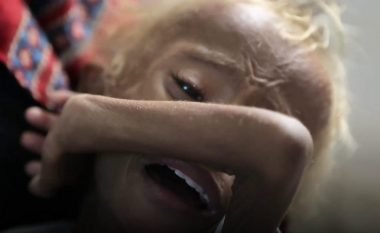 Vogëlushi që shokoi botën – ku gjendet ai tani? Reportazh prekës i BBC për pasojat e luftës së Jemenit (Video)