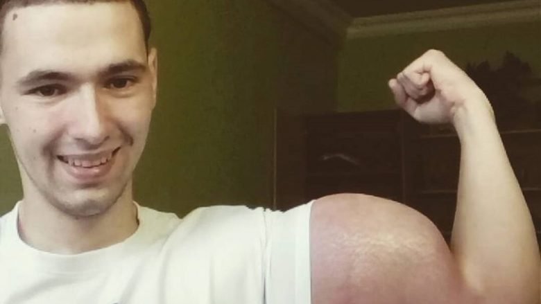 Njihuni me ish-ushtarakun që injektoi substanca të rrezikshme që ta ketë bicepsin dhe tricepsin si të Popeye (Foto)