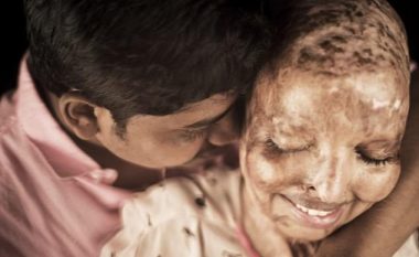 “Ai më do ashtu siç jam”: E mbijetuara e sulmit me acid gjeti dashurinë e jetës në spital – tani ata planifikojnë të martohen (Foto,+16)