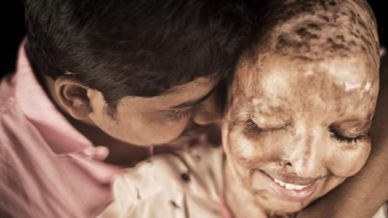 “Ai më do ashtu siç jam”: E mbijetuara e sulmit me acid gjeti dashurinë e jetës në spital – tani ata planifikojnë të martohen (Foto,+16)