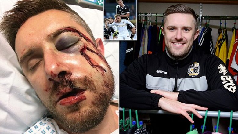 Lëndim horror në futbollin anglez: Yates lëndohet rëndë pas përplasjes me bashkëlojtarin e tij, rrezikon dëmtime afatgjate në hundë dhe sy (Foto)