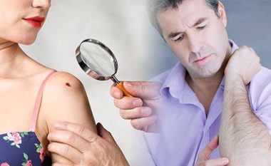 Simptomat e kancerit të lëkurës: Katër çrregullime që duhet t’ju çojnë tek doktori