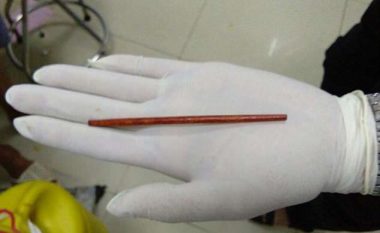 Mjekët ia nxjerrin shkopin nga organi gjenital, nuk e mban mend si kishte ndodhur! (Foto)