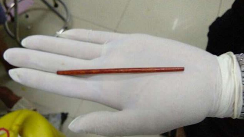 Mjekët ia nxjerrin shkopin nga organi gjenital, nuk e mban mend si kishte ndodhur! (Foto)