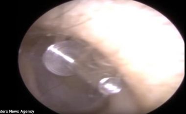 Vendosja e vathit nuk shkoi si duhet, mjeku ia nxori pjesën nga argjendi që i përfundoi te timpani (Video)