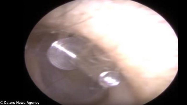Vendosja e vathit nuk shkoi si duhet, mjeku ia nxori pjesën nga argjendi që i përfundoi te timpani (Video)