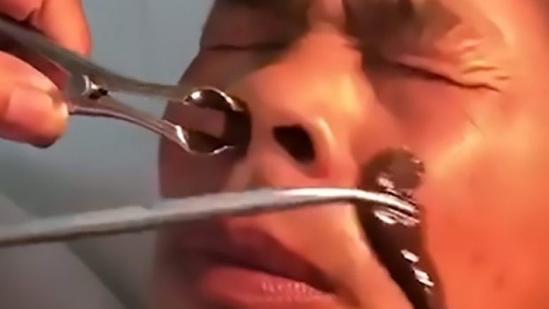 Mjeku ia nxori shushunjën që i kishte qëndruar në hundë për disa javë me radhë (Video)