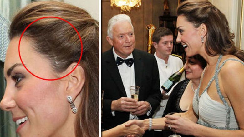 Kate Middleton ka një shenjë të ndërhyrjes kirurgjike në kokë që e ka fshehur mjeshtërisht për shumë vite