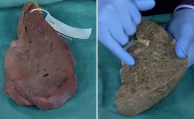 Shikoni si duket mëlçia e sëmurë nga cirroza pas një viti të konsumimit të alkoolit (Video)