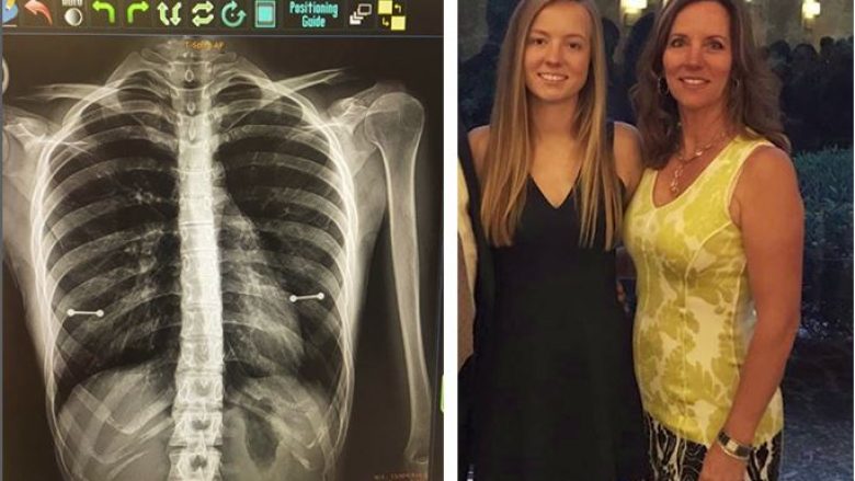 Nëna zbulon vathët e fshehtë të bijës falë radiografisë