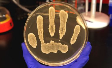 Bakteri i cili jeton në lëkurë gjithsecilin nga ne e ka bërë rezistues ndaj ilaçeve dhe në raste të këtilla mund të jetë fatal